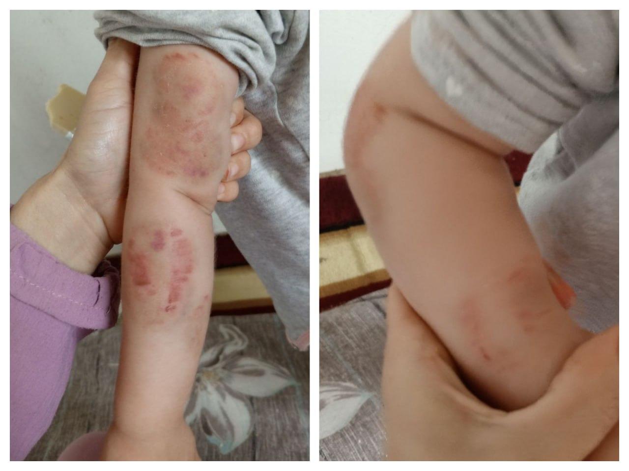 В одном из детских садов Самарканда у трёхлетней девочки обнаружили многочисленные укусы и гематомы