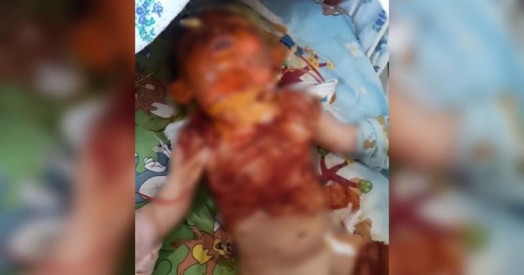 В Навоийской области ребенок получил 70 процентов ожогов тела