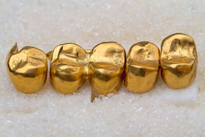 В Наманганской области мужчина украл золотые зубные коронки
