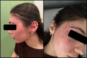 Urdi, pichoq bilan poʻpisa qildi va gʻoyib boʻldi: ayol sobiq erining shafqatsiz hujumidan omon qoldi